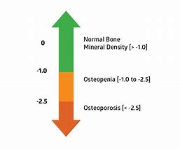 Image result for Bone Mineral Density Chart