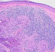 Image result for Angiosarcoma