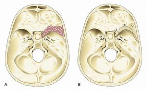 Image result for Meningioma Tumor Surgery Plates Screws