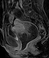 Image result for 5 Cm Fibroid in Uterus