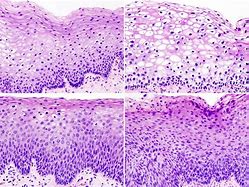 Image result for cervical intraepithelial neoplasia histology images