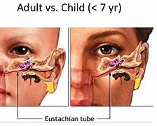 Image result for Eustachian Tube Adult versus Child