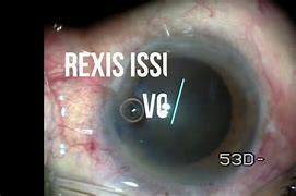 Image result for af�rexis