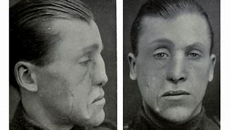 Image result for WWI Injuries