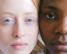 Image result for Myopia of Both Eyes