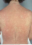 Image result for Types of Skin Allergies