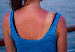 Image result for Sun Burn Kids