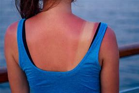 Image result for Sun Burn 2nd Degree Popped Blisters