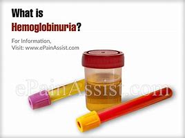 Image result for hemoglobinuria