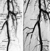 Image result for Left Leg Angiogram