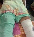 Image result for Child with Broken Leg