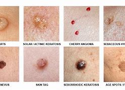 Image result for Cryotherapy Skin Lesion