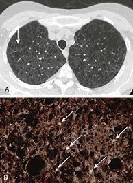 Результаты поиска изображений по запросу "Benign Lung Tumor"