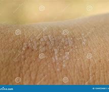 Image result for Sun Blisters On Hands