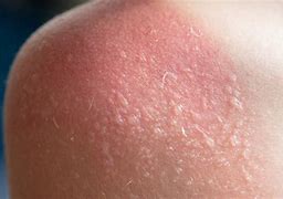 Image result for Sun Burn Skin Under a Microscope