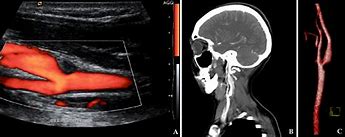 Image result for FMD Carotid Ultrasound