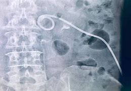 Image result for Percutaneous Nephrostomy Tube Bag