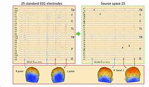 Image result for Polar Spikes EEG