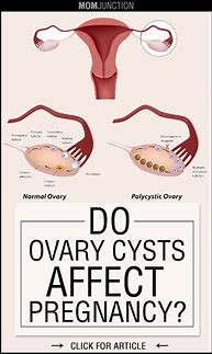 Image result for Pregnancy Cyst Ovary