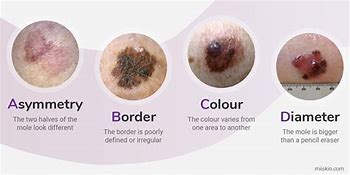 Image result for Untreated Melanoma