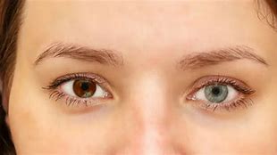 Image result for Barva OCI Sectral Heterochromia