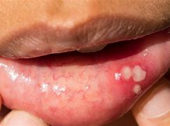 Image result for Chlamydia On Lips