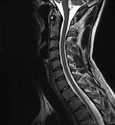 Image result for Cervical Spine MRI Thecal Sac