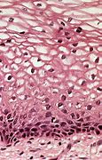 Image result for Head and Neck Cancer HPV