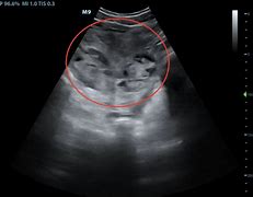 Image result for Pregnancy with Fibroids
