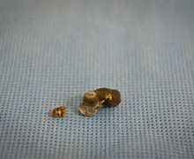 Image result for Kidney Stone Look Like