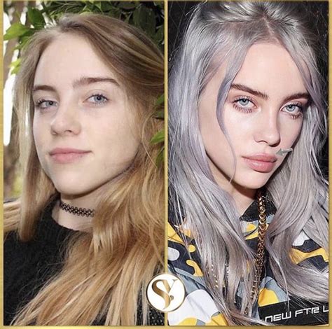 Billie Eilish Teeth Before And After