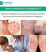Image result for Toddler Molluscum