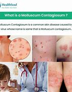 Image result for HPV Disease