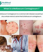 Image result for Human Papillomavirus How Do You Get It
