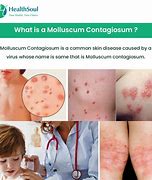 Image result for Picture Human Papillomavirus HPV