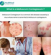 Image result for Papilloma On Human Skin