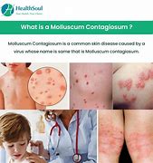 Image result for HPV Warts vs Molluscum