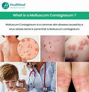 Image result for Molluscoum Contagiosum Treatment