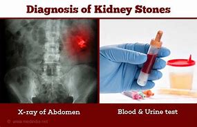 Image result for Diagnosis of Kidney Stones