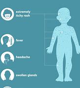 Image result for Chickenpox Transmission