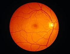 Image result for What Is a Detached Retina in the Eye