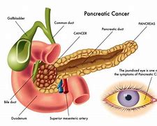Image result for Benign Tumor On Pancreas