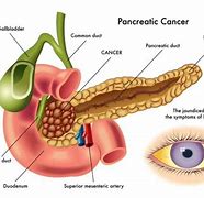 Image result for 2 Cm Tumor On Pancreas