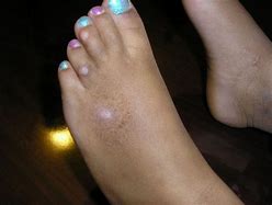 Image result for Molluscum On Feet