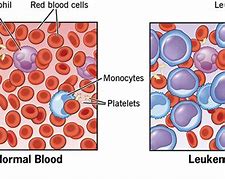 Image result for Leukemia White Blood Cells