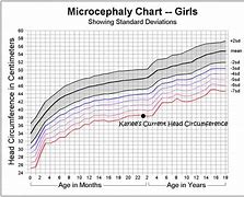 Image result for Microcephaly Head Size