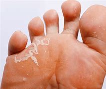 Image result for Toddler Athlete's Foot