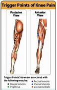 Image result for Knee Pain Trigger Points
