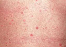 Image result for Chickenpox Vesicles