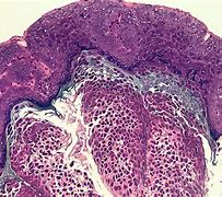 Image result for Molluscum Images